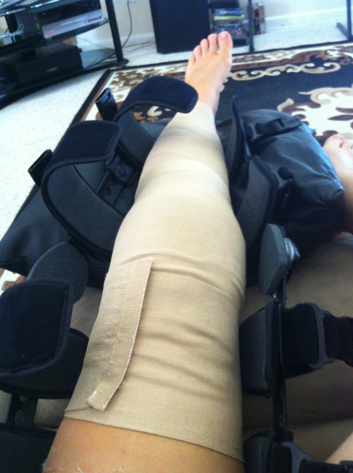 MPFL Reconstruction and Microfracture Knee Surgery