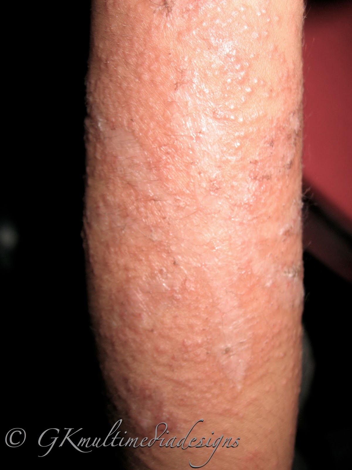 Could Verdugo'S Tattoo Allergy Change The Industry Forever? - lxyveg2