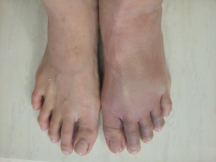Surviving as a Working Mum in Malaysia 5th Metatarsal fracture journey of healing