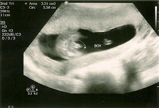 3d ultrasound at 14 weeks 3d ultrasound at 14 weeks