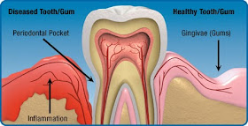 Gum problems treatment