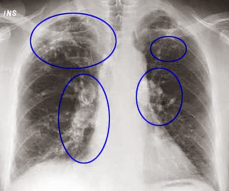 Silicosis – An Incurable Lung Condition - Dream Health
