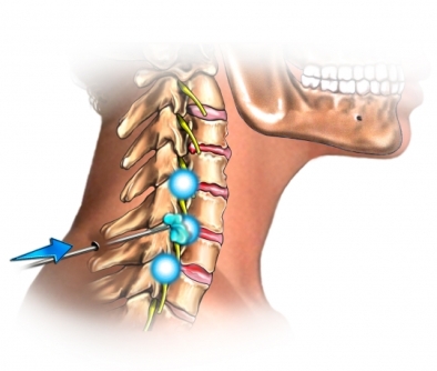 Steroid injections for neck and shoulder pain