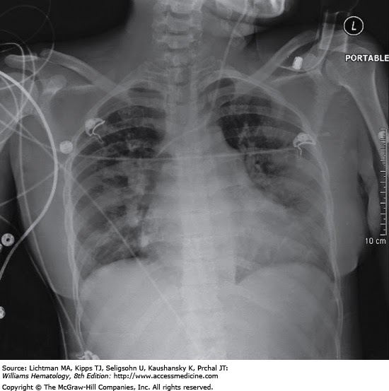 acute chest syndrome azithromycin