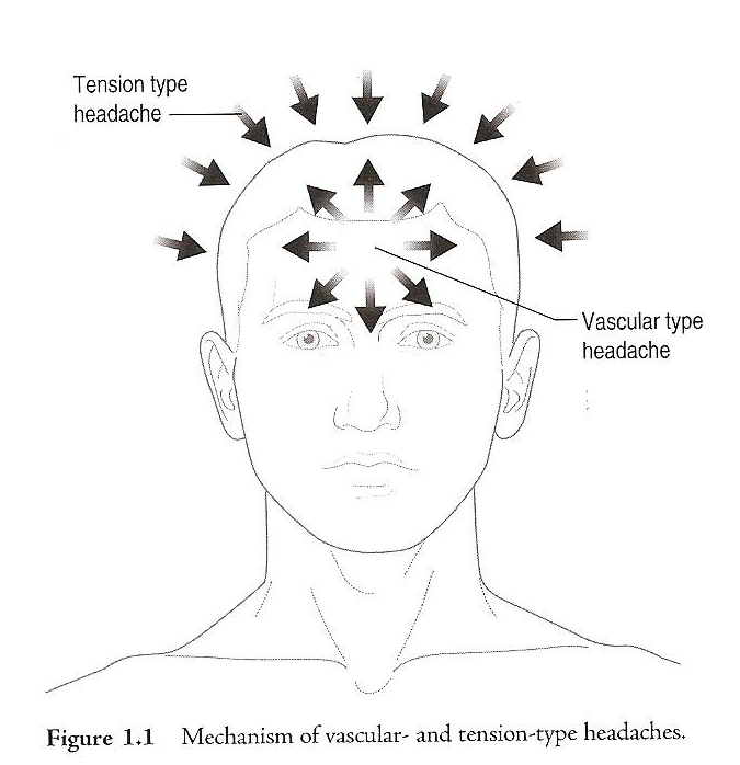 Sandy Fritz Vascular or Tension Headache