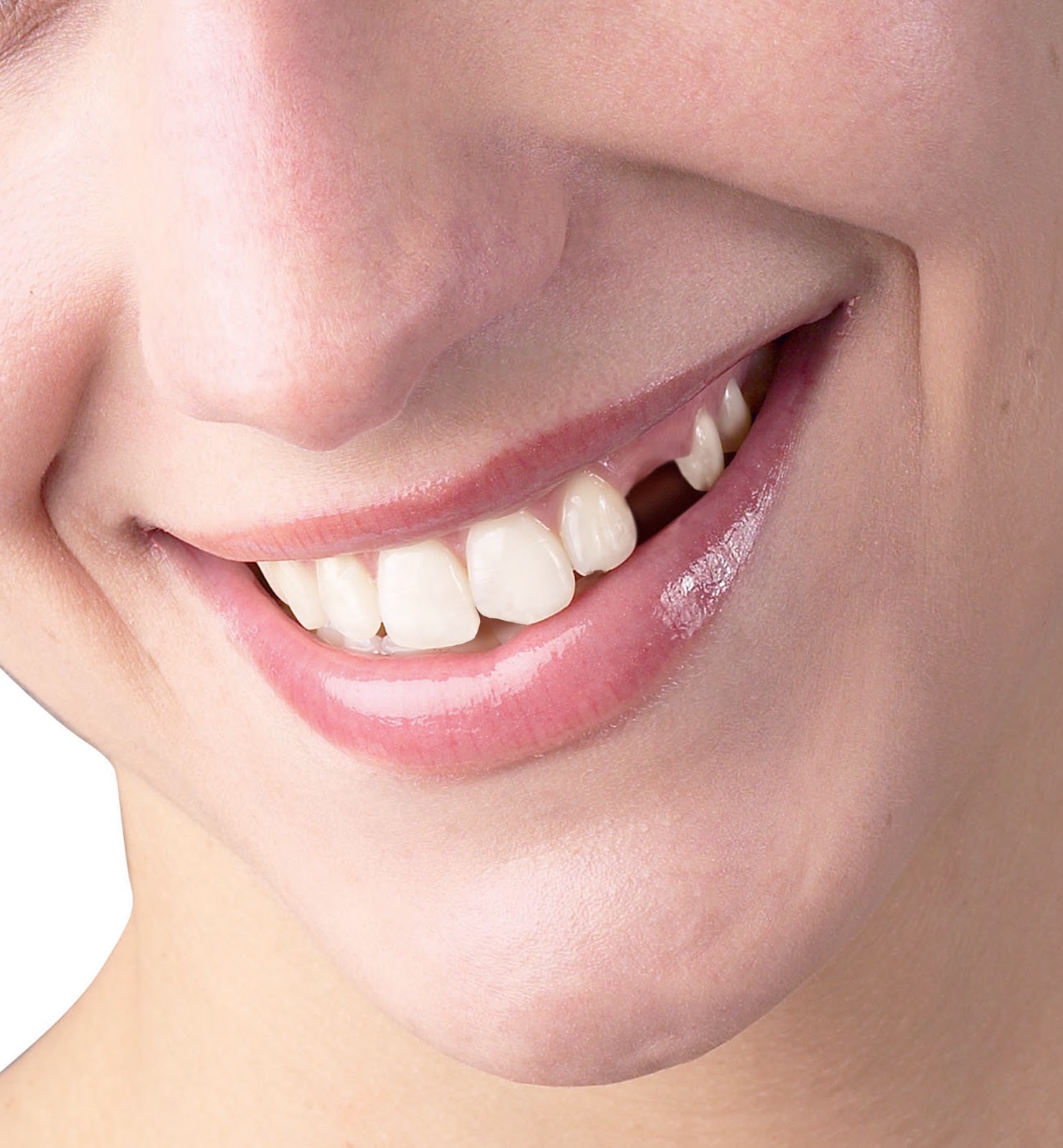 missing teeth tooth row among