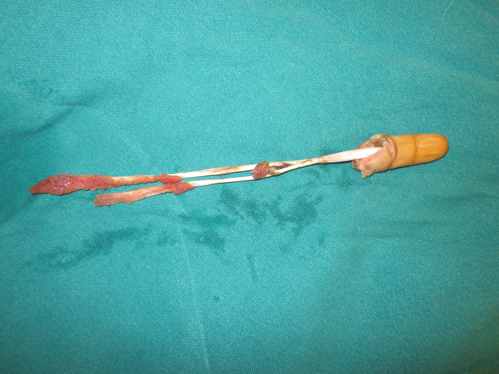 CRUSH INJURIES OF HAND AND UPPER LIMB INJURIES DOG BITE AVULSION