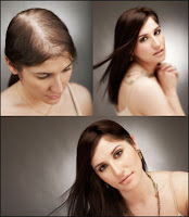 hair transplant women