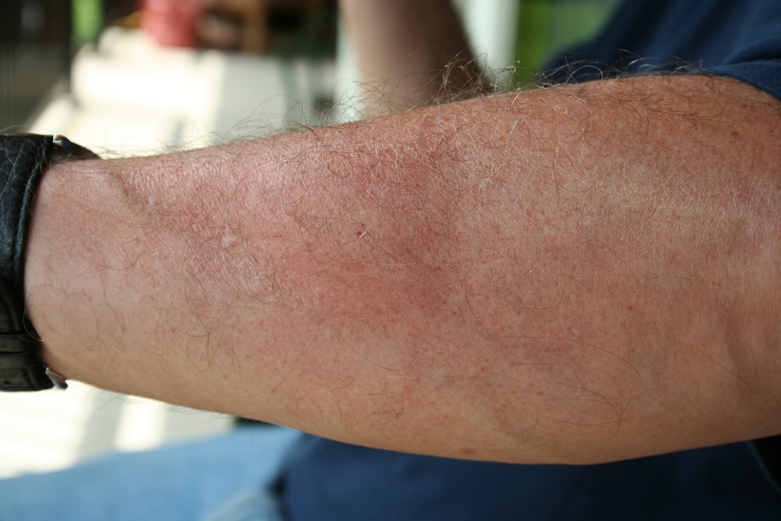 Ontario Healthcare for those over 50 Lyme Disease in Canada