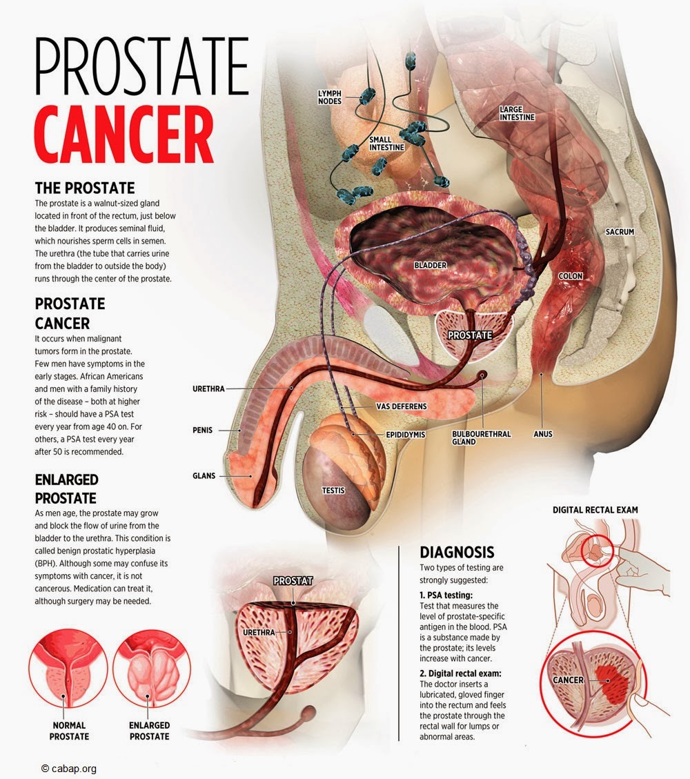 prostate cancer 