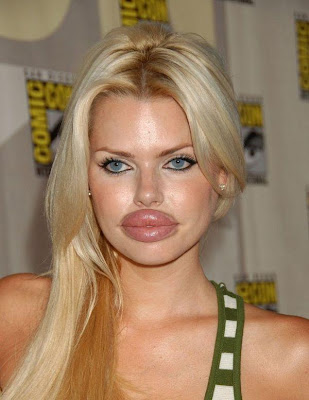 It seems that her lips are just Inflated to perform a bounce kissing If her profession is in the limelight of Media. Her lips are huge, bigger than a normal lips look, worse lips surgery ever, lips augmentation did not contribute to this girl. Can anyone guess why this girls's lips augmentation went wrong?