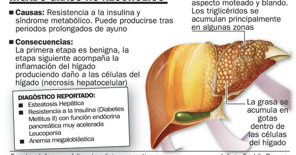 Los 5 Enemigos Del Higado: HÍGADO GRASO Los 5 Enemigos Del Higado: HÍGADO GRASO