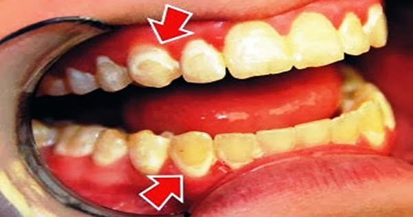 teeth coffee stained stain drinks foods smile