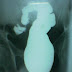 Malignant Ascites Malignant Ascites