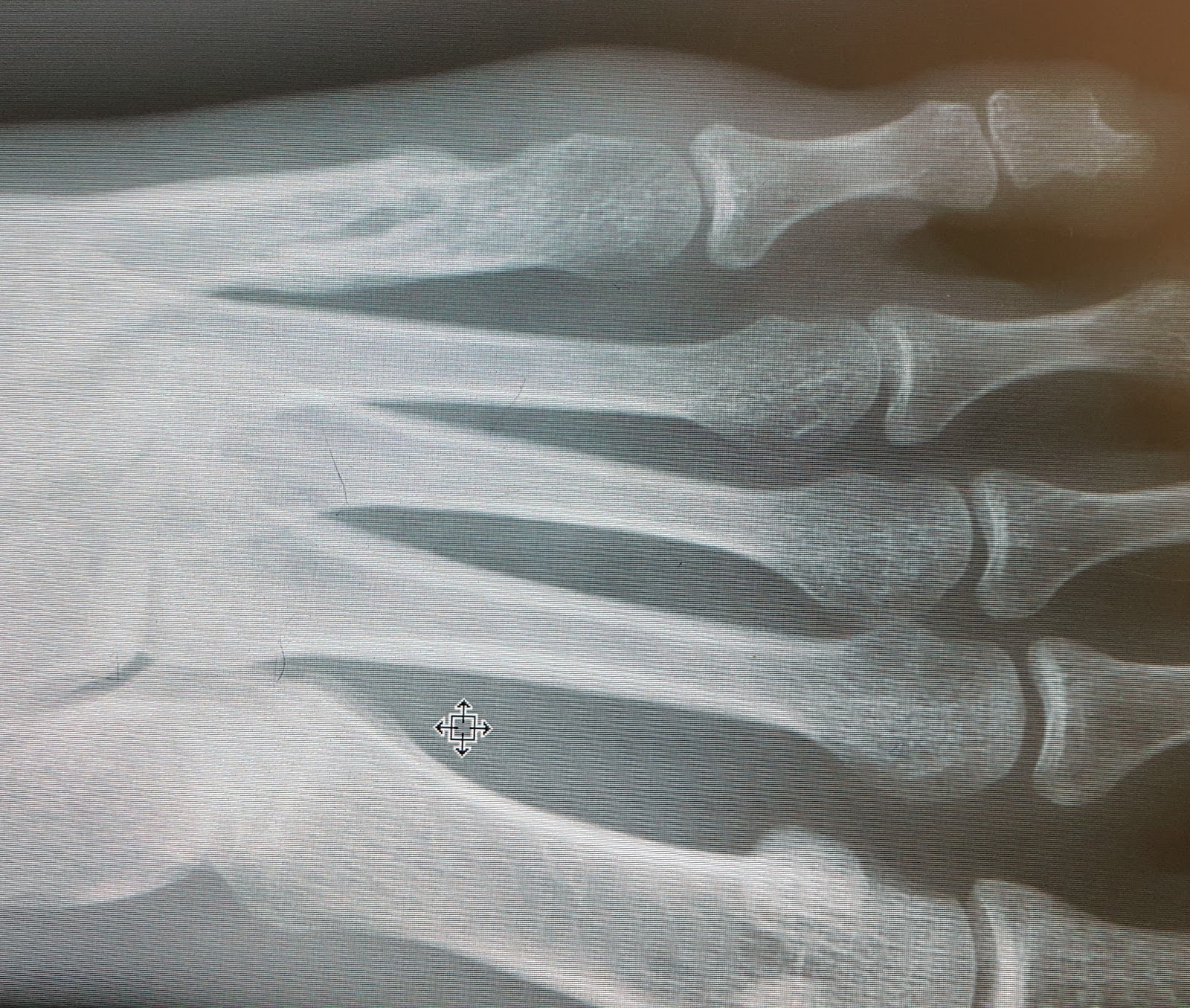 5th metatarsal fracture not healing jhBos