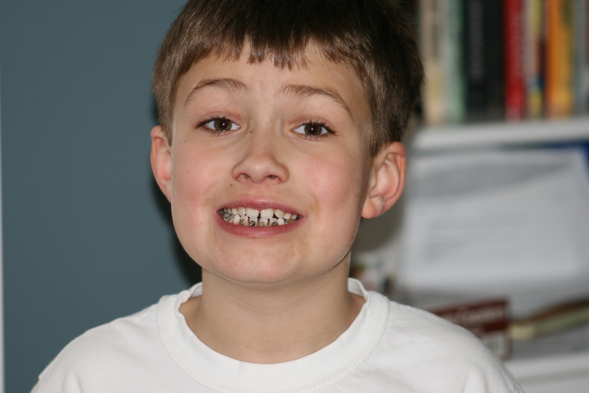 CHD Blog www.One in 1 Hundred. Braces... at Seven years Old?