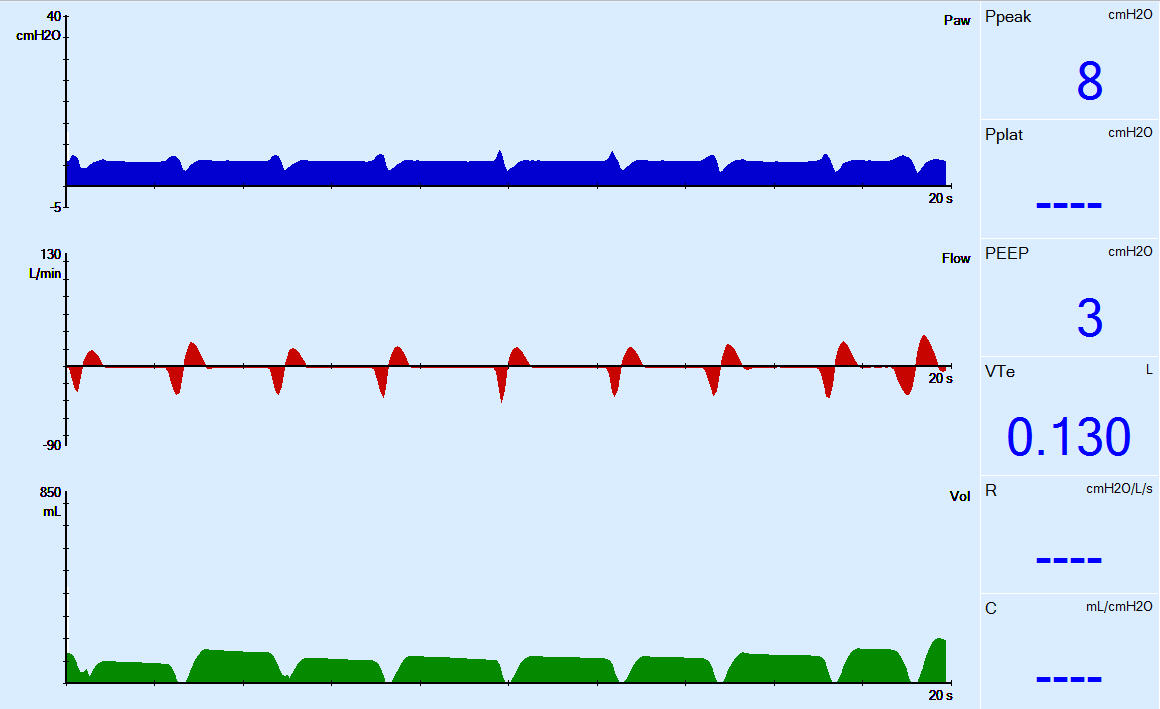 FREMITUS CPAP as a LOW TIDAL VOLUME VENTILATION STRATEGY