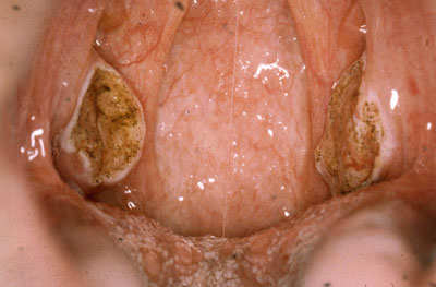 El dolor en el cuello y el vértigo y la náusea