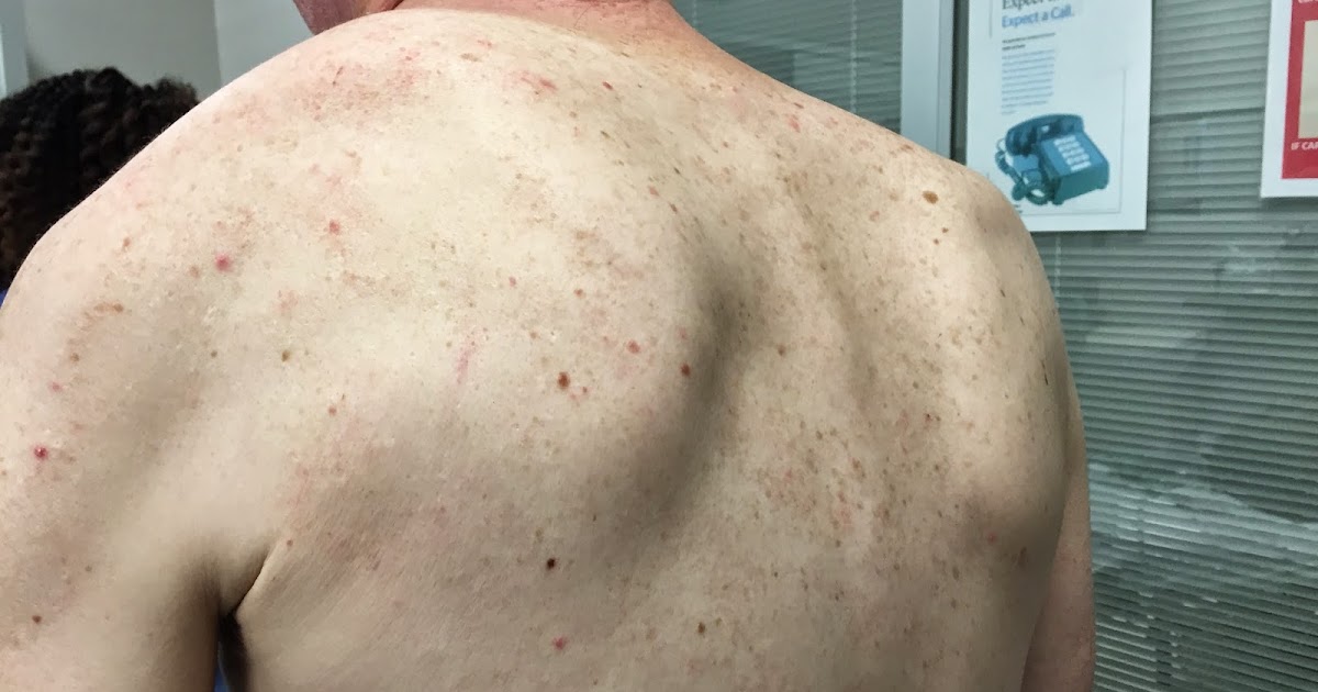 Shoulder and Elbow Surgery Locked scapula syndrome (or scapular