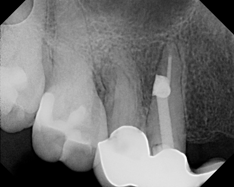 The Endo Blog Root Canal Surgery to Repair Post Perforation