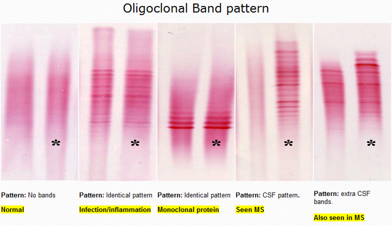 oligo bands csf positive and oligo bands serum 2 oligo bands csf positive and oligo bands serum 2