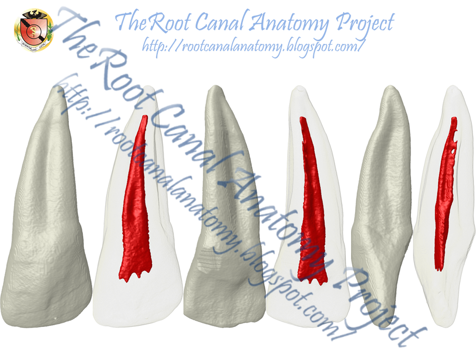 The Root Canal Anatomy Project Radicular Groove Maxillary Incisors
