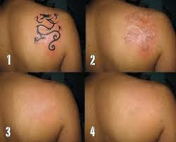 testimoni-2-pakai-penghapus-tatto-tattonox.jpg