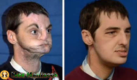 Americano ganha novo rosto 15 anos depois graças a transplante inédito