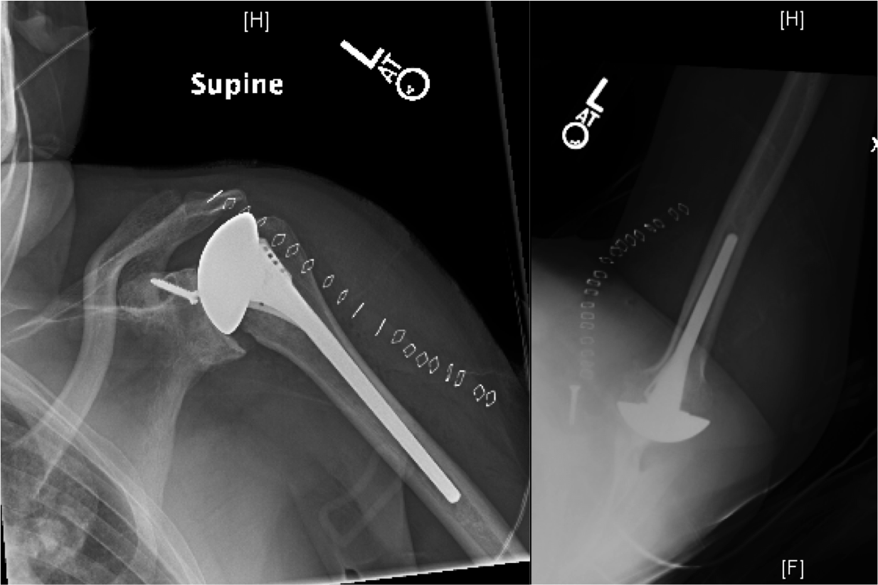 Shoulder Arthritis / Rotator Cuff Tears causes of shoulder pain Ream