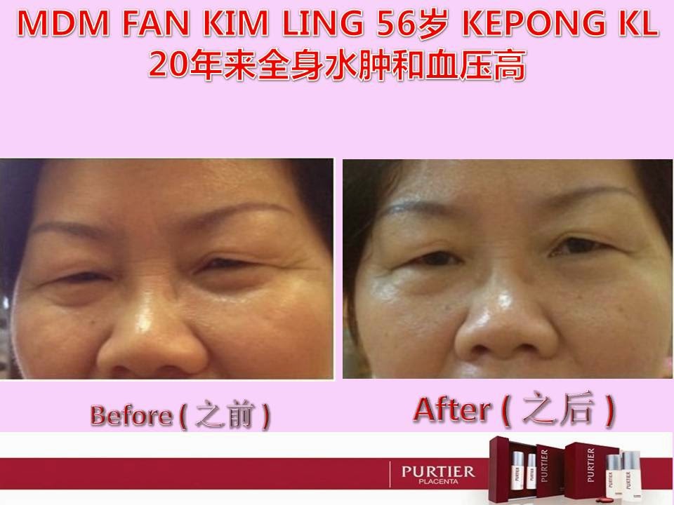 MDM FAN KIM LING (56) KEPONG KL-20 YEARS WATER RETENTION WHOLE BODY & HYPERTENSION