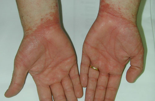 La psoriasis de la parte pilosa de la cabeza en el ejército