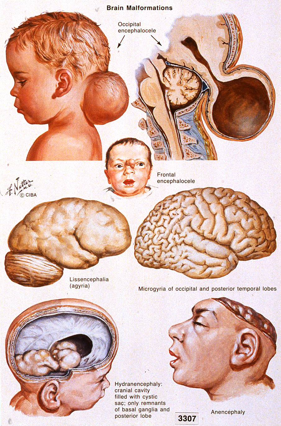 Hydrocephalus as related to Head and Brain Malformations Pictures