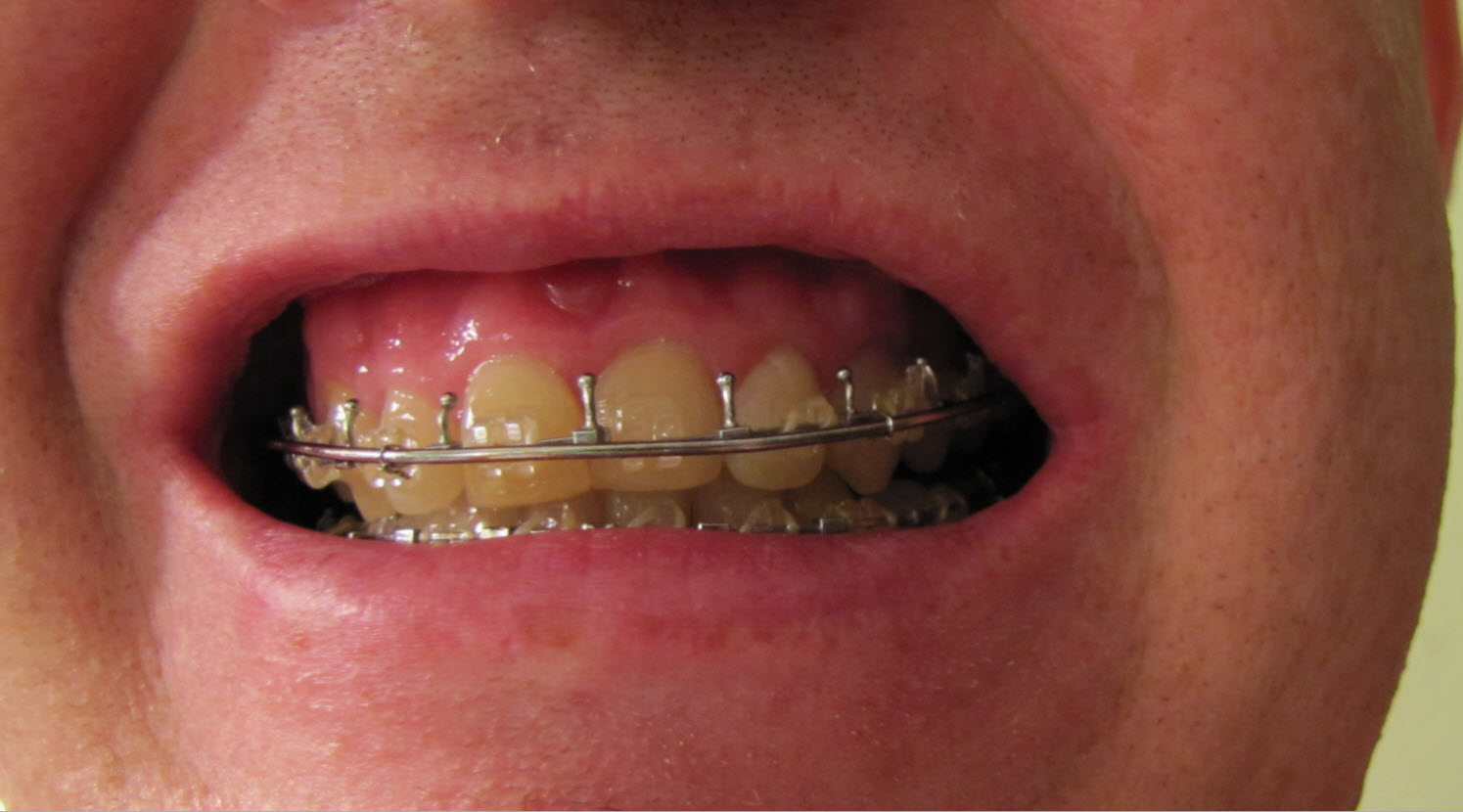 wire jaw brace double talking again