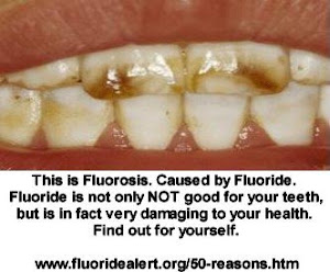 dental fluorosis...