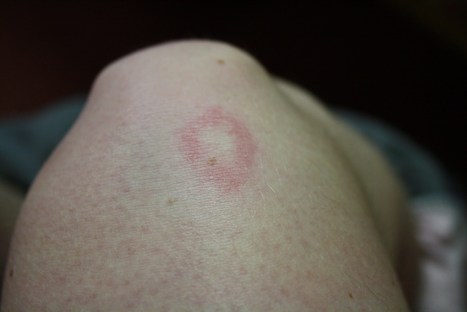 Bruise With Dot In Middle at Samantha Feldmann blog