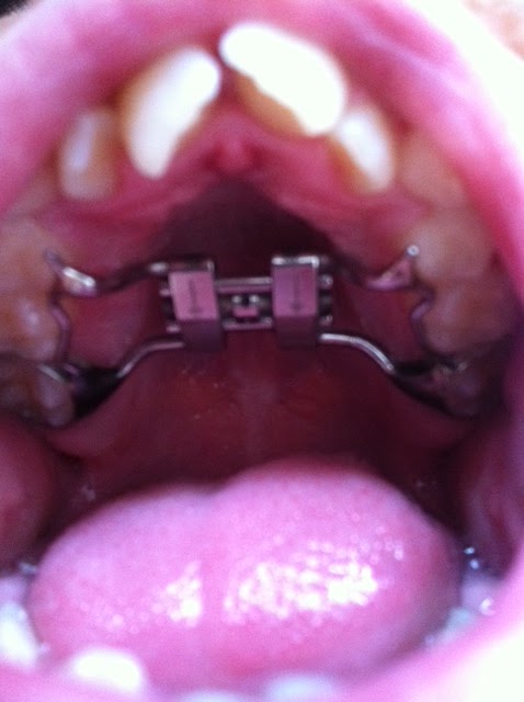 expander olds teeth does braces hurt tooth palete straighter journey help turning