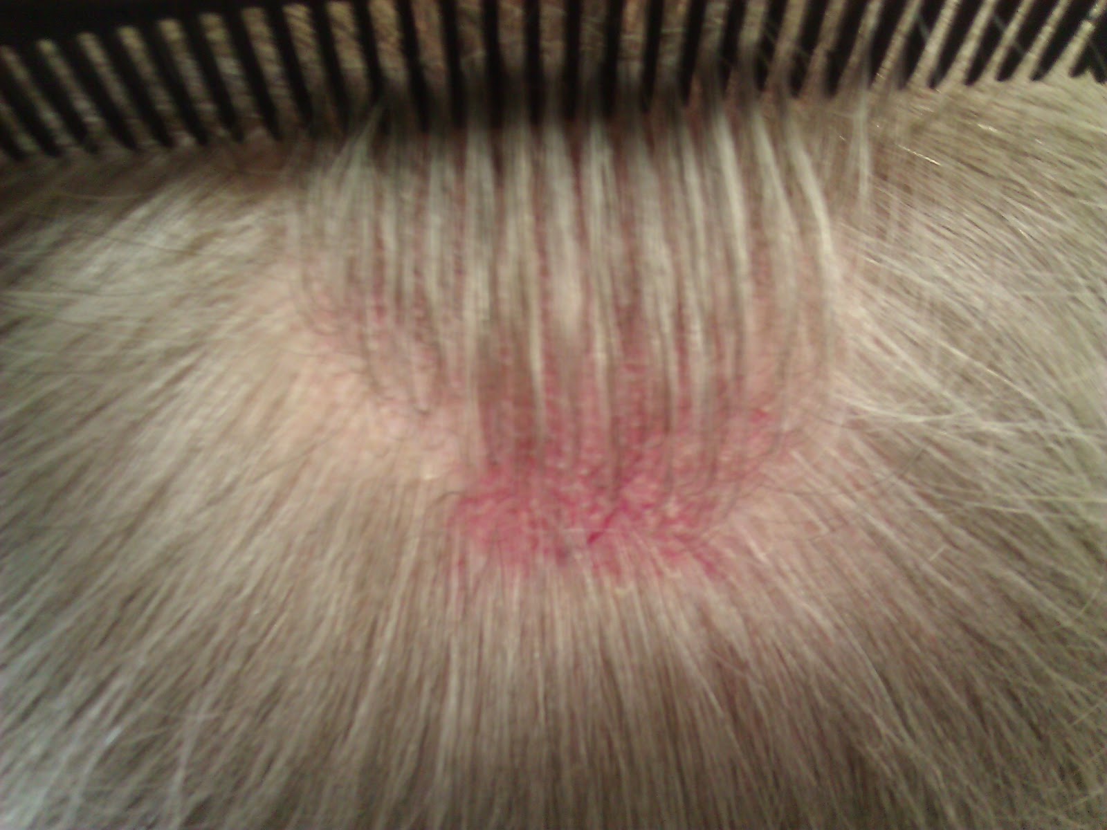 Sore Patch On My Head