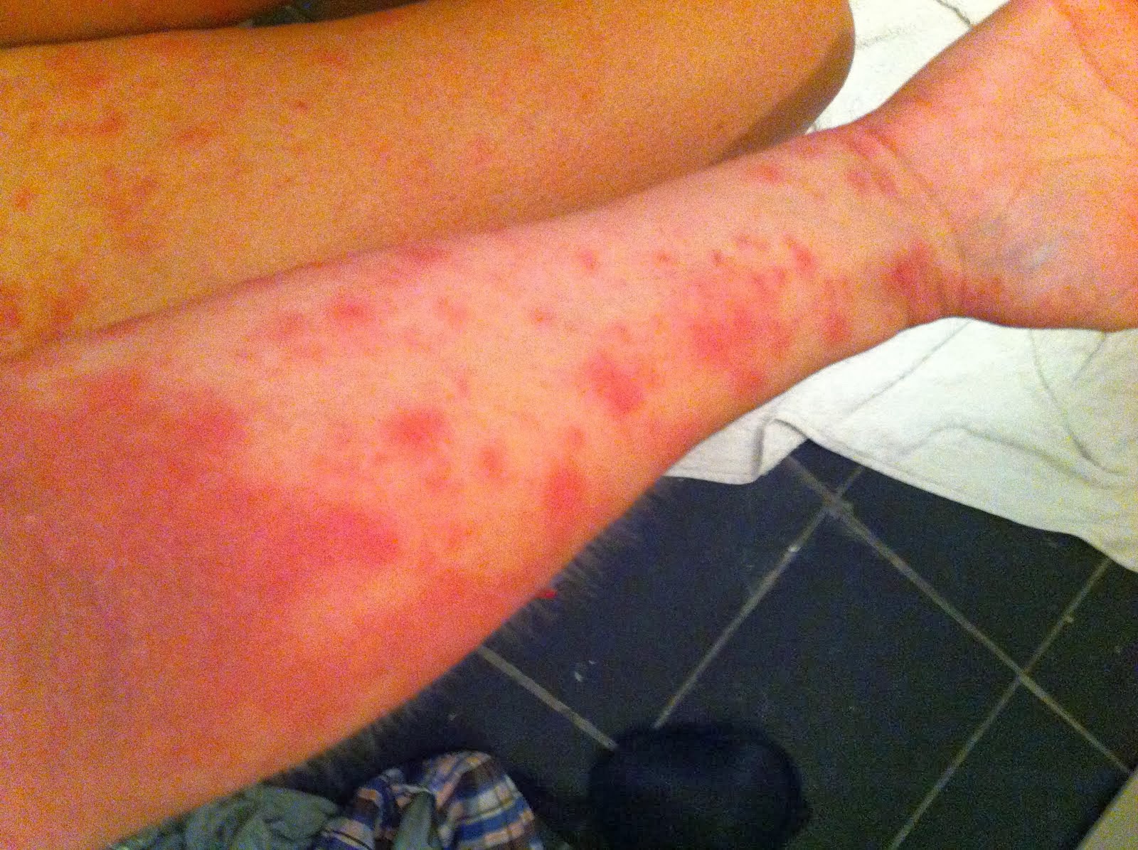 My Eczema Pictures - The first