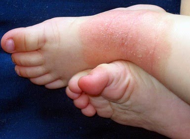 eczema on baby