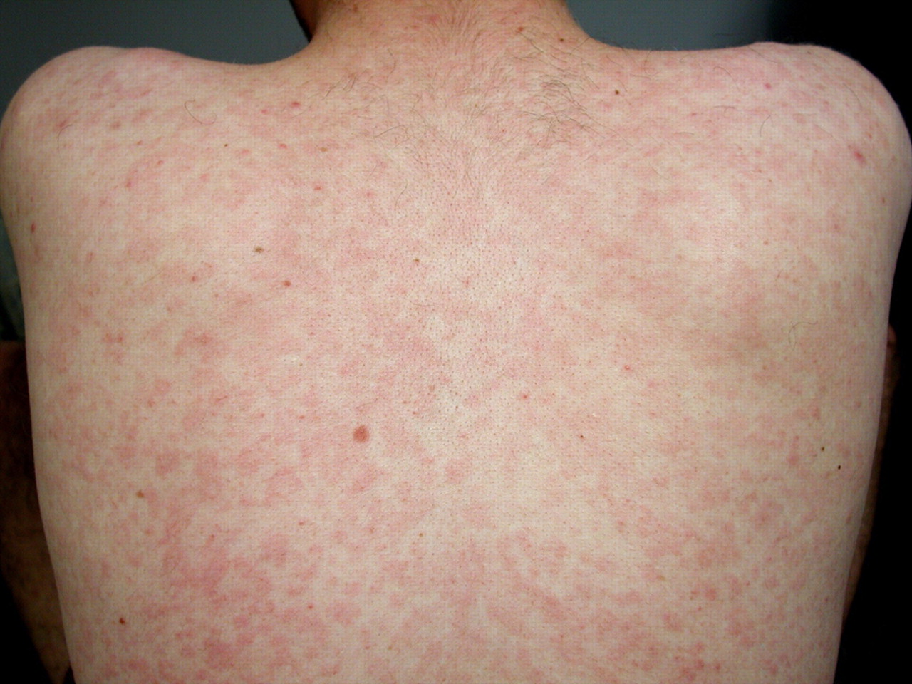 Aids Rash – Something To Notice And Be Aware Of - Hiv Aids Cure