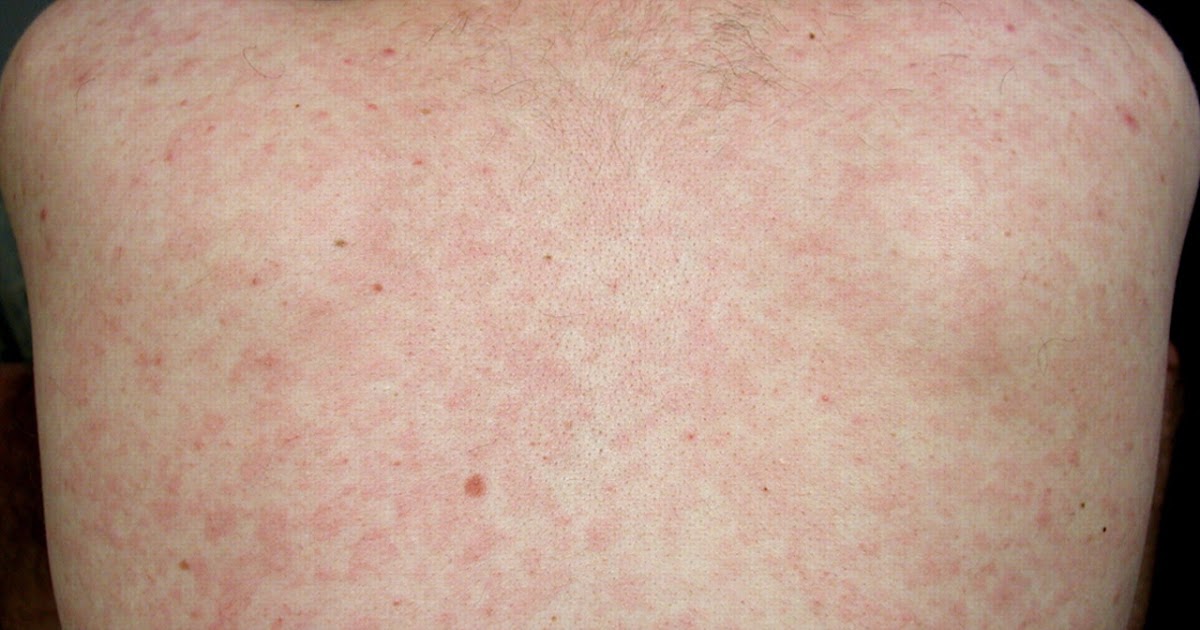 Hiv Rash On Face How To Identify An Hiv Rash Youtube vrogue.co