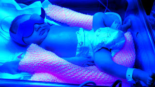 premature jaundiced baby under billi lamps