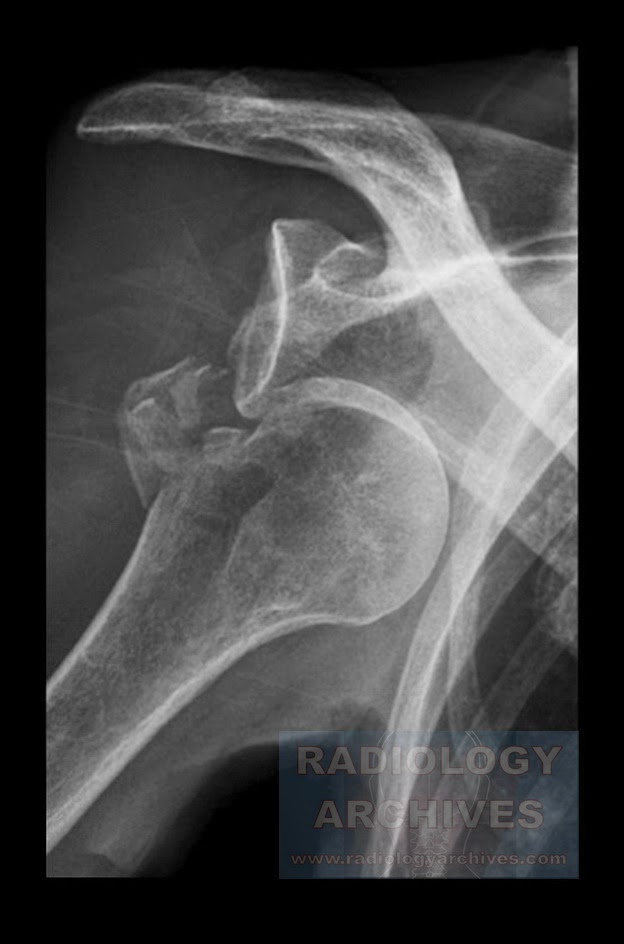 Radiology Archives Βλάβη Hill Sachs* (Πρόσθιο Εξάρθρημα Ώμου με
