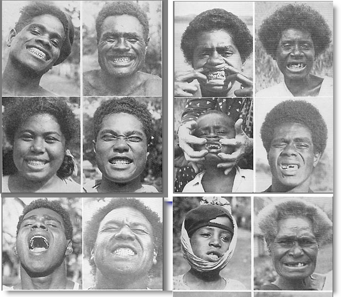 Health, Fitness Naturally! Is wisdom tooth