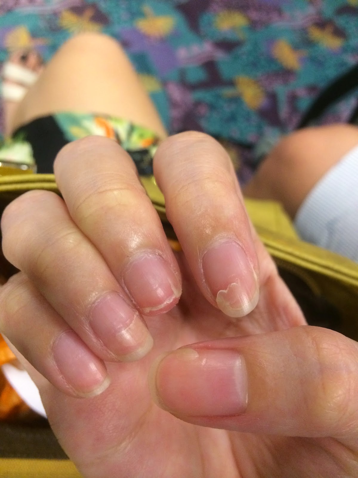 The Dettol Diaries: Peeling Fingernails after HFMD