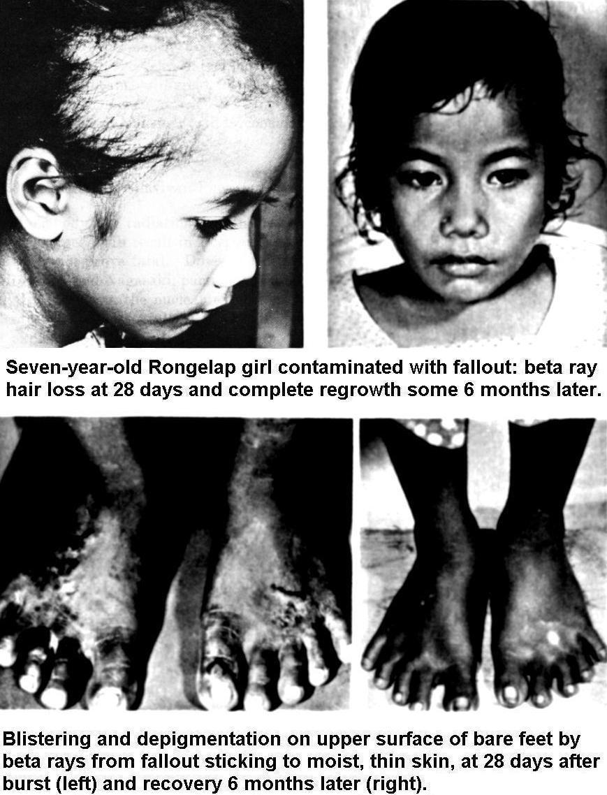 Image result for the effects of nuclear radiation on Marshall islanders
