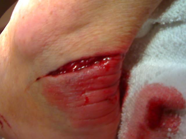 hand laceration pictures
