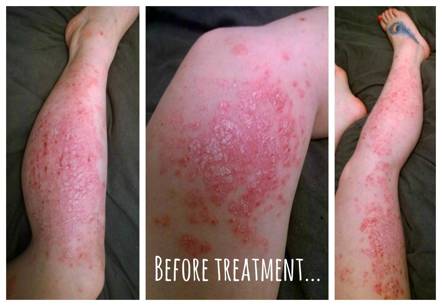 My psoriasis an update after two weeks of light therapy