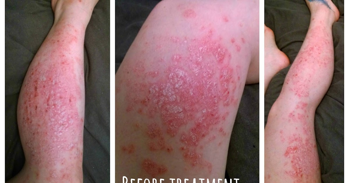 My psoriasis an update after two weeks of light therapy To Mum