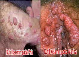kutil kelamin pria dan wanita